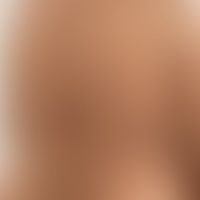 Grinspan-Syndrom: Klinische Zeichen des Pemphigus vulgaris. Abb. entnommen aus: Saddik A et al. 2...