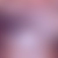 Becker Naevus in Assoziatio... Becker Naevus in Assoziation mit Vitiligo und Lichen planus (Abb. entnommen aus: Gupta S et al. (...