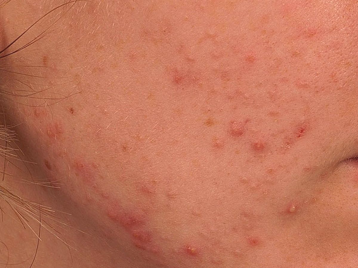 Akne Ubersicht Altmeyers Enzyklopadie Fachbereich Dermatologie