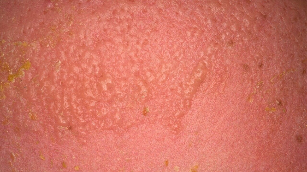Verbrennung - Altmeyers Enzyklopädie - Fachbereich Dermatologie, image size:1280x720