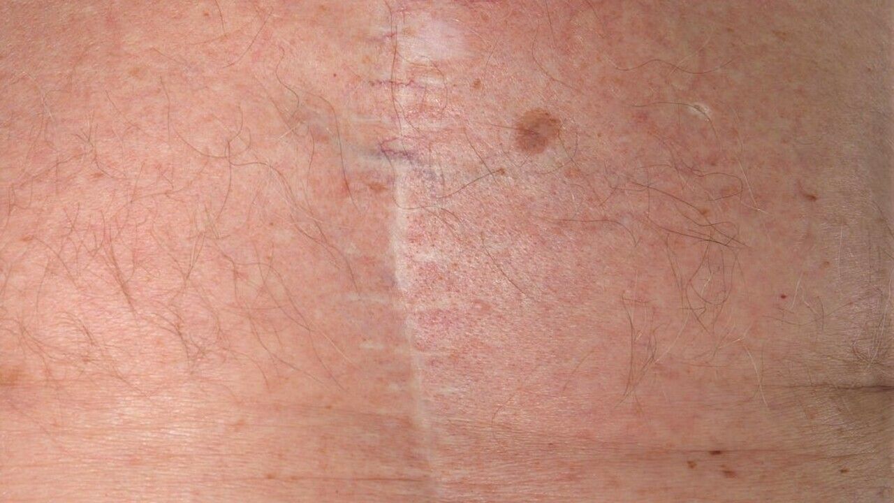 cigarette paper skin Scar - Altmeyers Encyclopedia