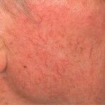 Teleangiektasie Altmeyers Enzyklopädie Fachbereich Gefäßmedizin