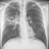 Aspergillose (Übersicht) Bilder - Altmeyers Enzyklopädie - Fachbereich Innere Medizin