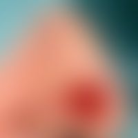 Insellappen, myokutaner: Defekt am Übergang vom Nasenflügel zur Nasenspitze
