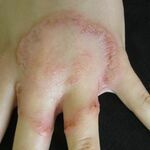 Benhamiae trichophyton - Altmeyers Encyclopedia - Department Dermatology