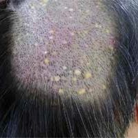 Steatocystoma multiplex Bilder Altmeyers Enzyklopädie Fachbereich