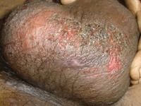 eczema on scrotum