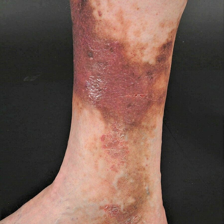Chronic venous insufficiency (overview) - Altmeyers Encyclopedia