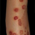 Pyodermie - Altmeyers Enzyklopädie - Fachbereich Dermatologie