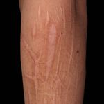 BlaschkoLinien Altmeyers Enzyklopädie Fachbereich Dermatologie