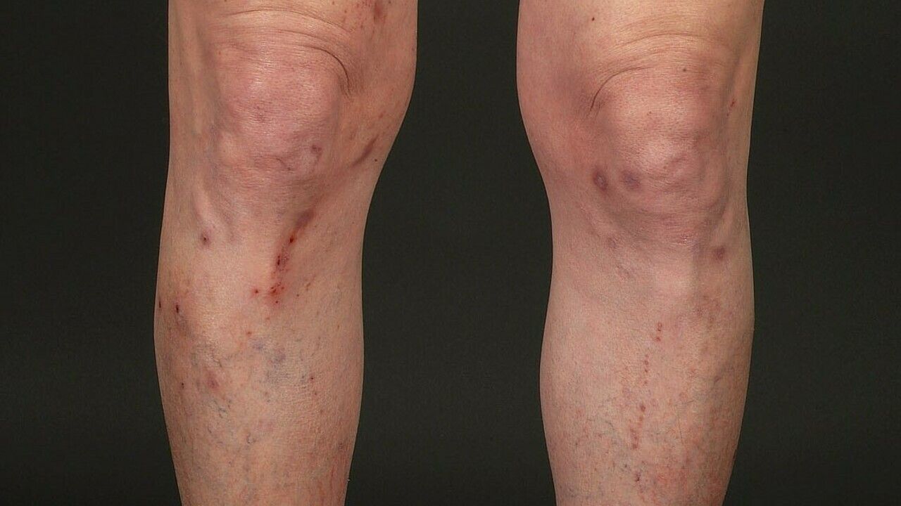 flegmon varicose