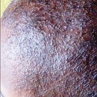 Keratosis follicularis spinulosa decalvans Bilder - Altmeyers ...