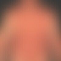 Pityriasis rubra pilaris (a... Pityriasis rubra pilaris (adulter Typ), Rückenansichtseit: Jahren chronisch-rezidivierender Verla...