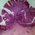 Condylomata gigantea Altmeyers Enzyklopädie Fachbereich Dermatologie