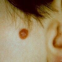 Nevus spitz Bilder - Altmeyers Enzyklopädie - Fachbereich Dermatologie