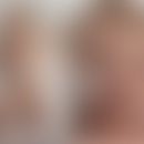 Vici-Syndrom: Albinismus (Säugling türkische Herkunft), Vergröberung der Gesichtszüge mit vollen ...