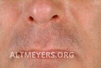 Folliculitis barbae - Altmeyers Encyclopedia - Department Dermatology