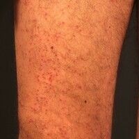 Folliculitis superficial Images - Altmeyers Encyclopedia - Department ...