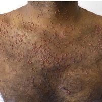 Xanthogranulome (Übersicht) Bilder Altmeyers Enzyklopädie