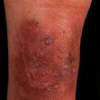 Pyoderma gangraenosum Images - Altmeyers Encyclopedia - Department ...