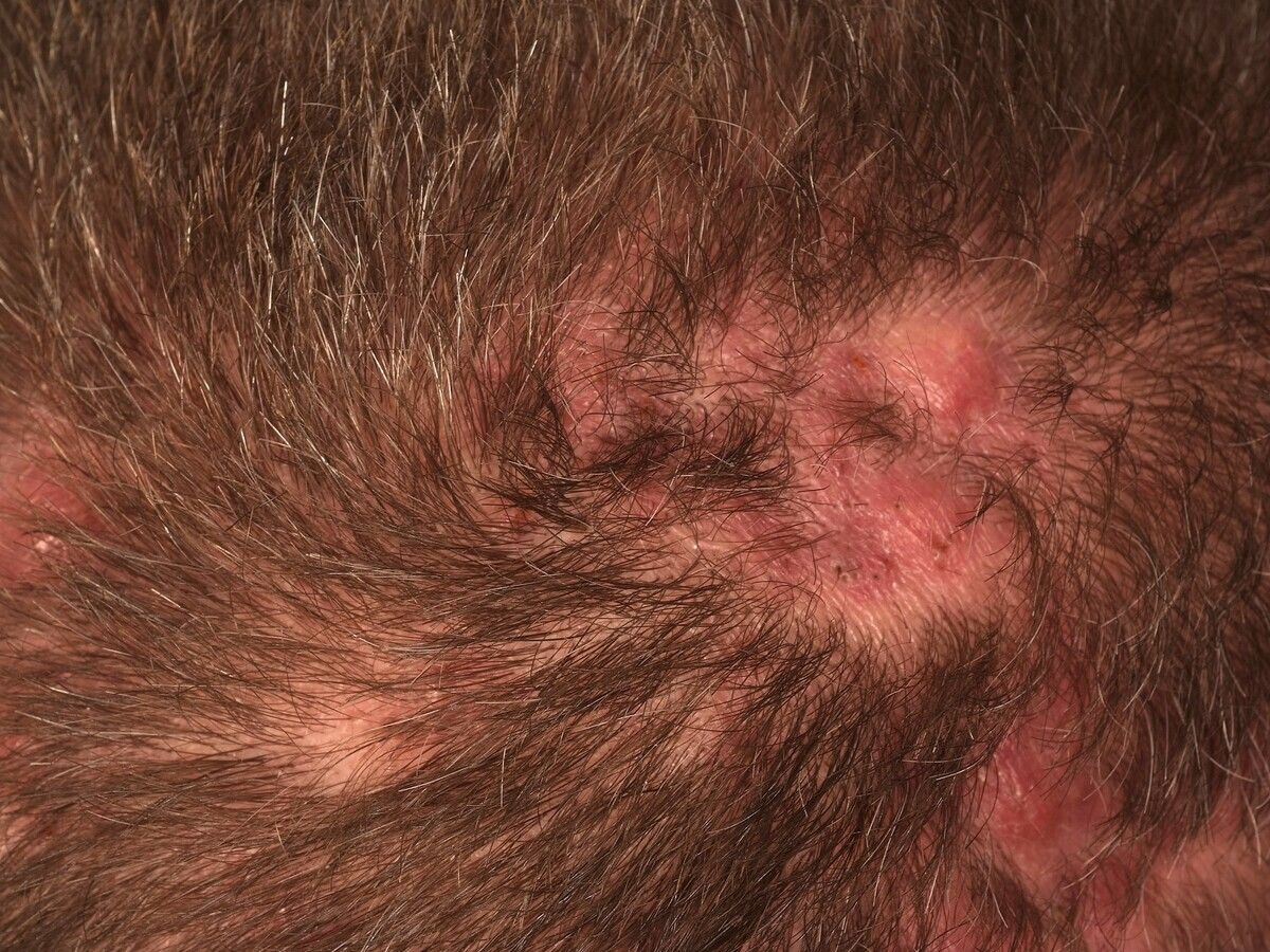 Folliculitis decalvans - Altmeyers Encyclopedia - Department Dermatology Folliculitis decalvans - Altmeyers Encyclopedia - Department Dermatology