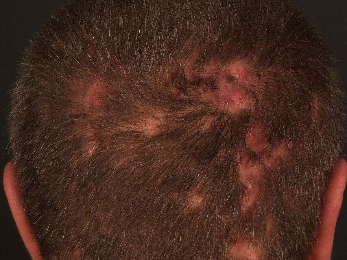 Folliculitis decalvans - Altmeyers Encyclopedia - Department Dermatology Folliculitis decalvans - Altmeyers Encyclopedia - Department Dermatology