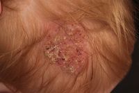 Tinea capitis (overview) - Altmeyers Encyclopedia - Department Dermatology