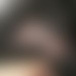 Lichen ruber follicularis capillitii: Mann, 44 Jahre, iranischer Herkunft. 2021 schonmal Schub mi...