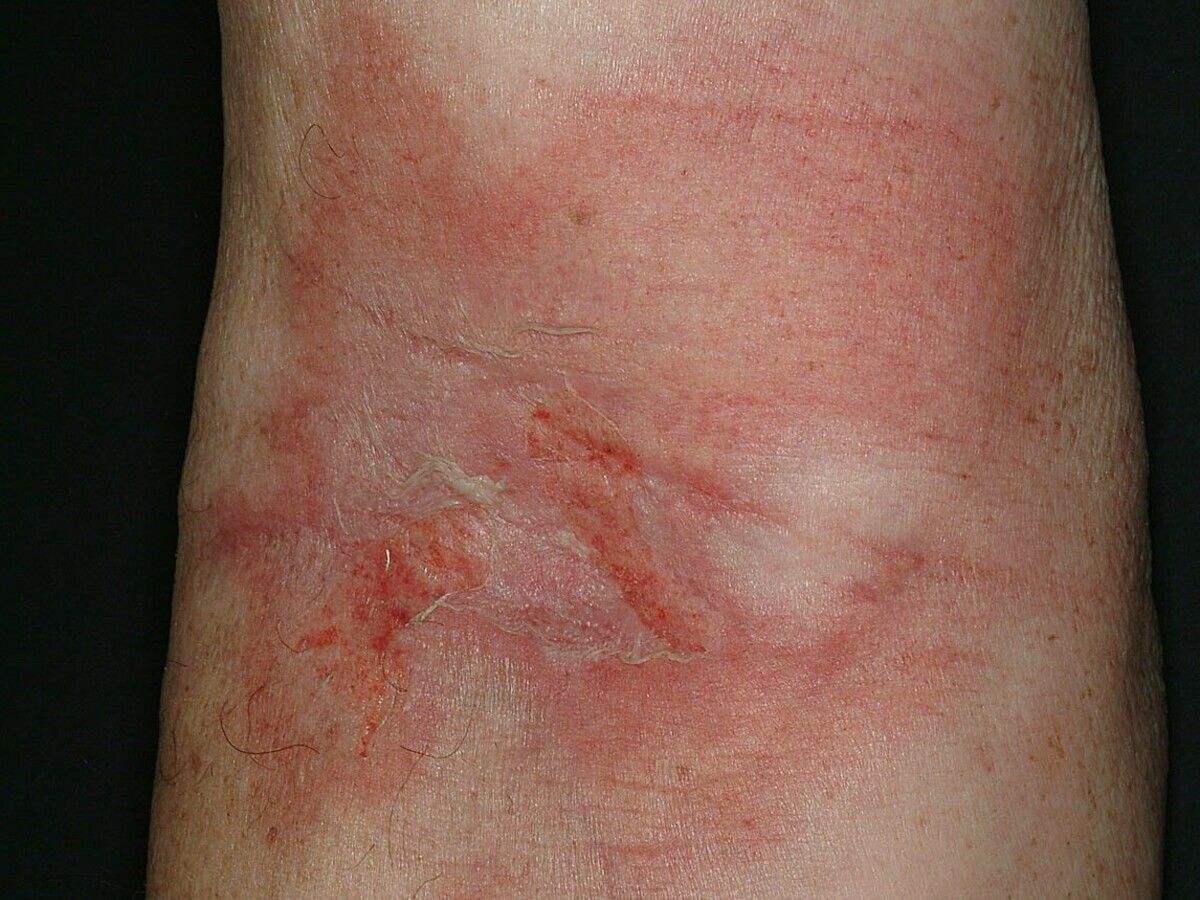 Verbrennung - Altmeyers Enzyklopädie - Fachbereich Dermatologie, image size:1200x900