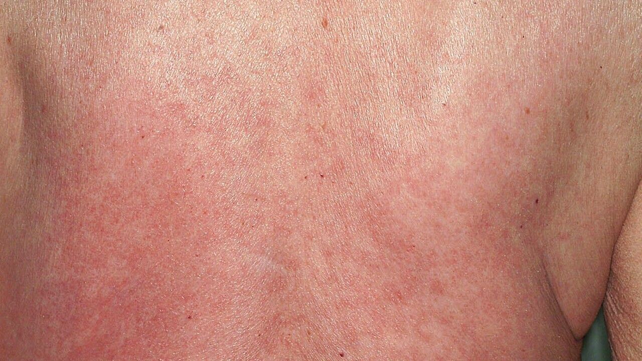 American Journal of Case Reports | Recurrent Cellulitis-Like Episodes of  the Lower Limbs and Acute Diarrhea in a 30-Year-Old Woman: A Case Report -  Article abstract #932732, image size:1280x720