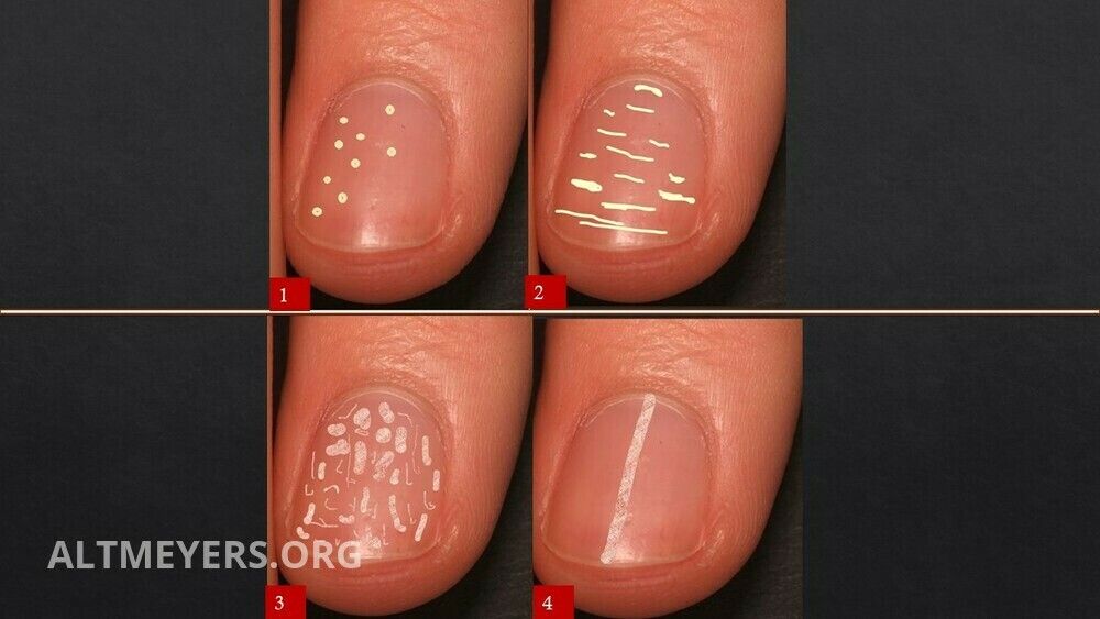 Nail diseases (overview) - Altmeyers Encyclopedia - Department Dermatology