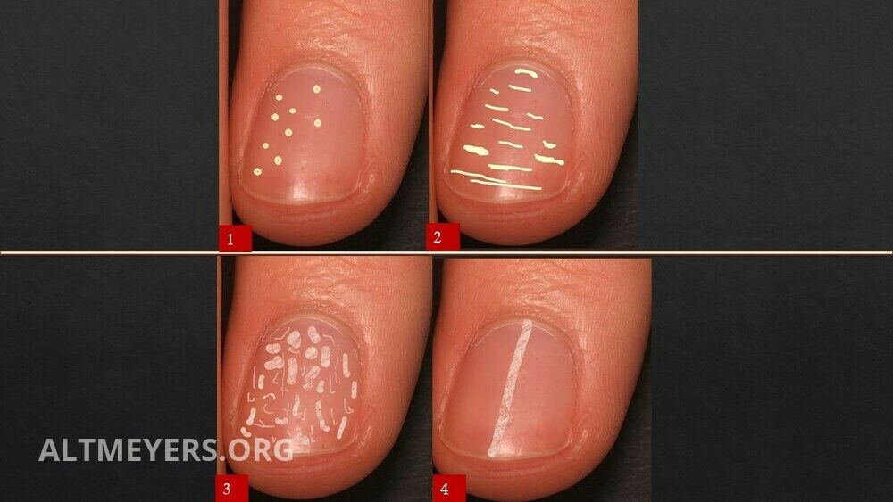 Nail diseases (overview) - Altmeyers Encyclopedia - Department Dermatology Nail diseases (overview) - Altmeyers Encyclopedia - Department Dermatology