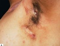 Dermesthetic - Hidradenitis Suppurativa (HS) also known as acne inversa is  a skin disease that usually begins as pimples in the armpits (usually both  armpits) or in the groin (pubic area). It