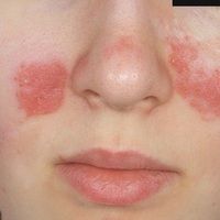 Systemic Lupus Erythematosus-Causes-Symptoms-Diagnosis-Treatment-Homeopathic Treatment-Best Homeopathic doctor-Dr Qaisar Ahmed-Al-Haytham clinic-Risalpur-KPK-Pakistan